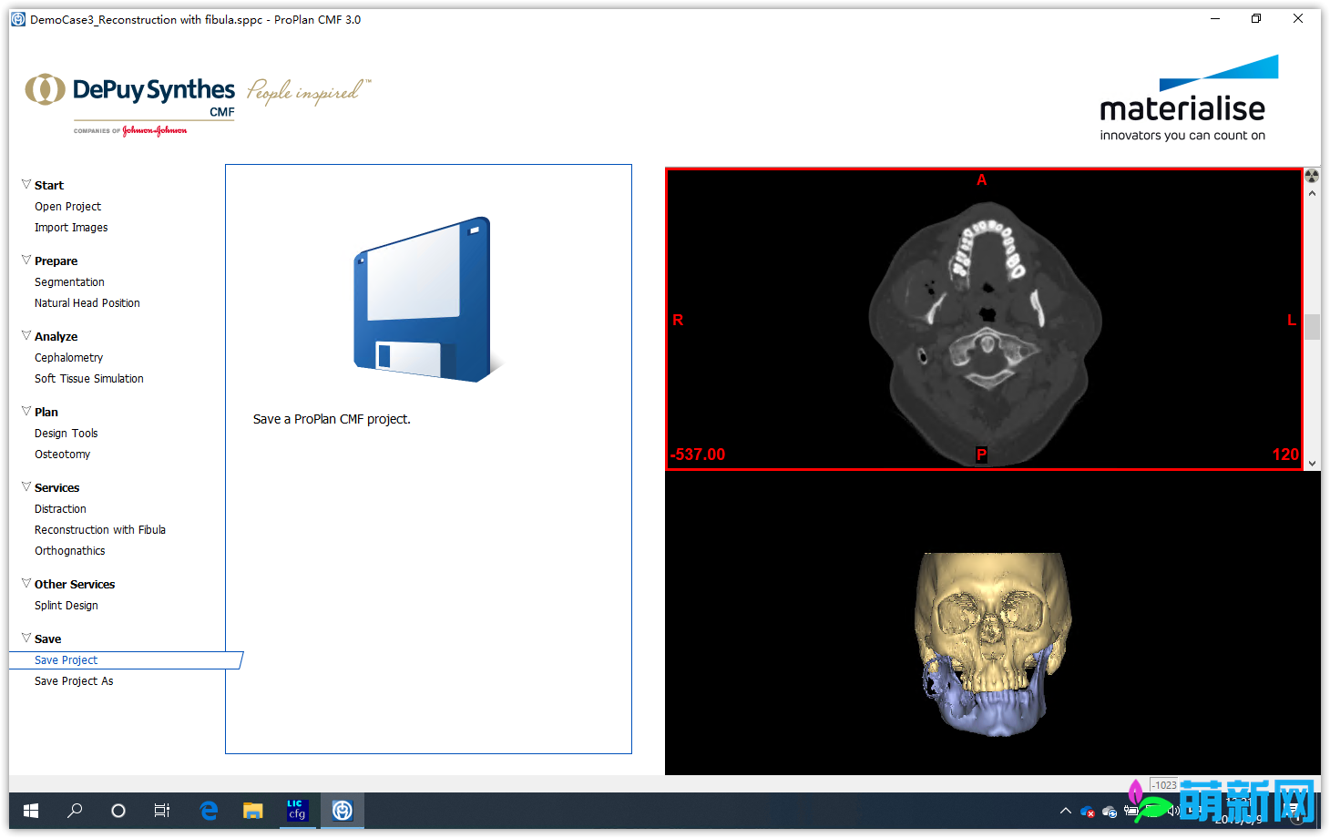 Materialise ProPlan CMF v3.0.1 完美激活版 强大的医学软件下载插图4