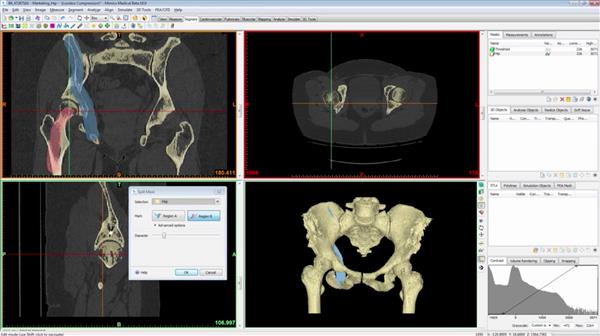 Materialise Mimics Innovation Suite 20.0 x64 官方原版 完美激活 crack 破解版下载插图